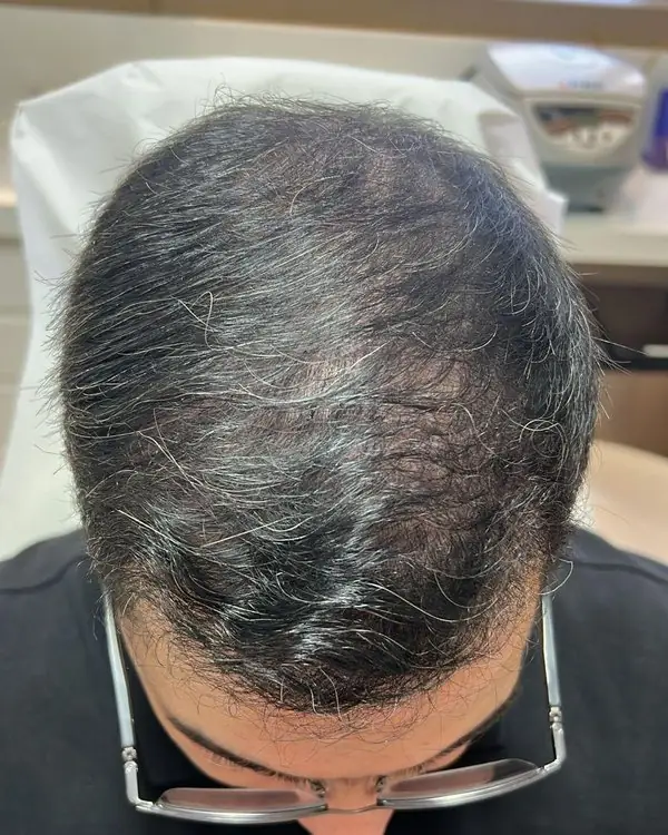 Paciente depois do transplante capilar