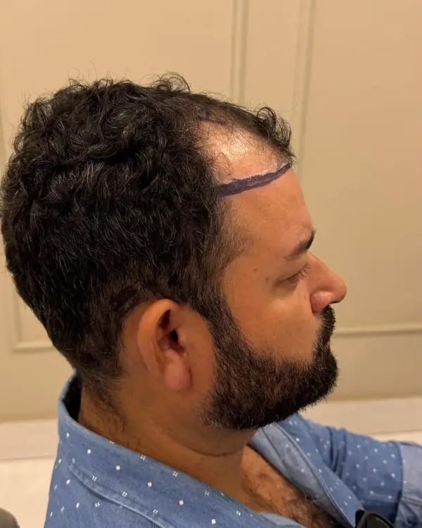 Paciente antes do transplante capilar, com marcação da linha capilar