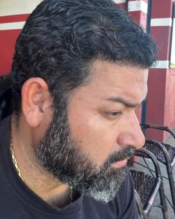 Paciente depois do transplante capilar