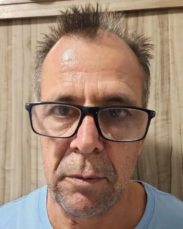Paciente antes do transplante capilar